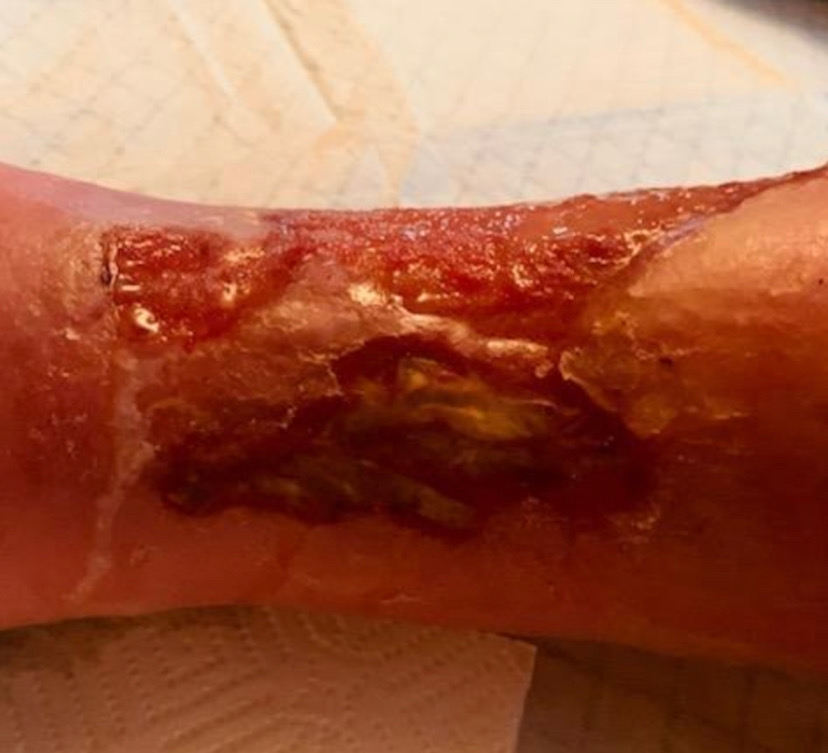 Side wound after 2 1/2 years of traditional wound treatment