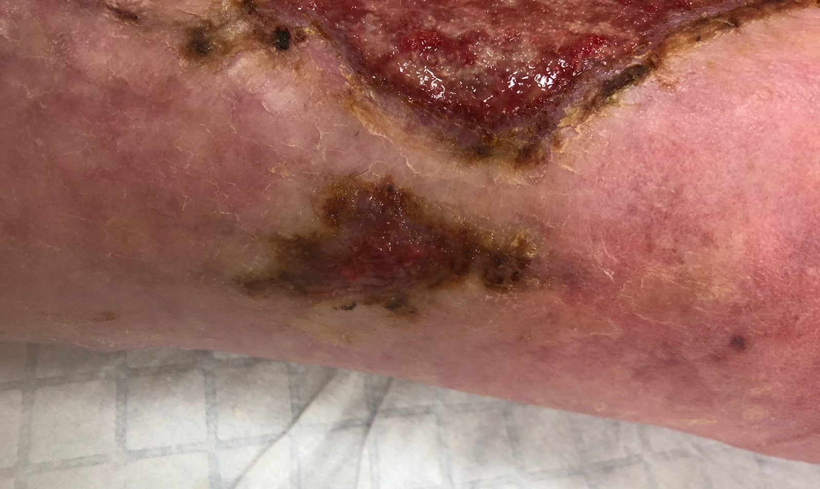Side wound showing clear separation from top wound