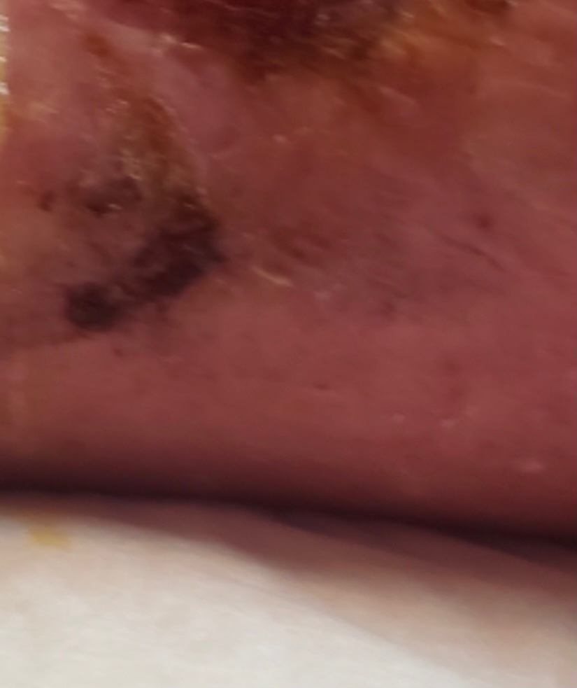 Side wound magnified 10x showing complete healing
