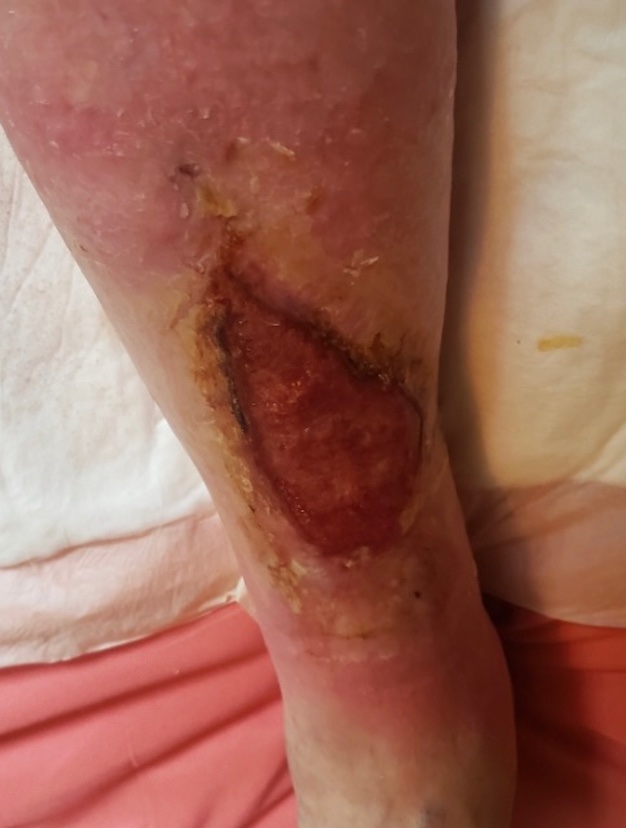 Top wound showing continued healing and shrinkage