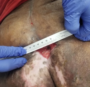 Wound after 7 weeks of treatment using Restore Wound Care's protocol