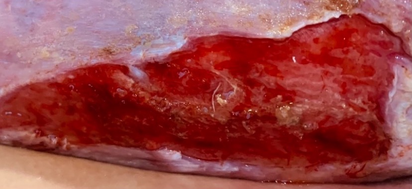 Left leg after 5 years of treatment