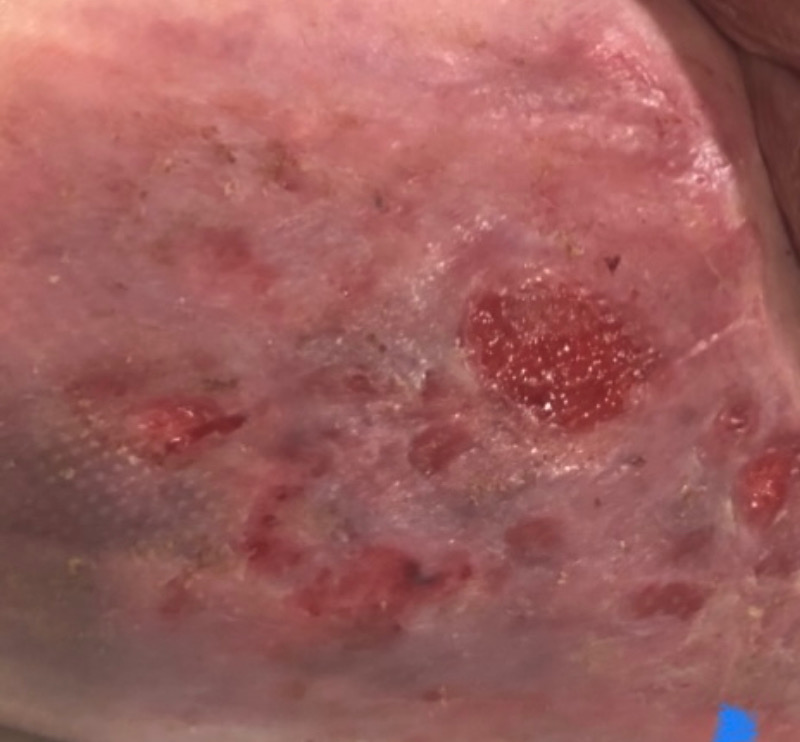 Right after 21 days of treatment with Restore Wound Care